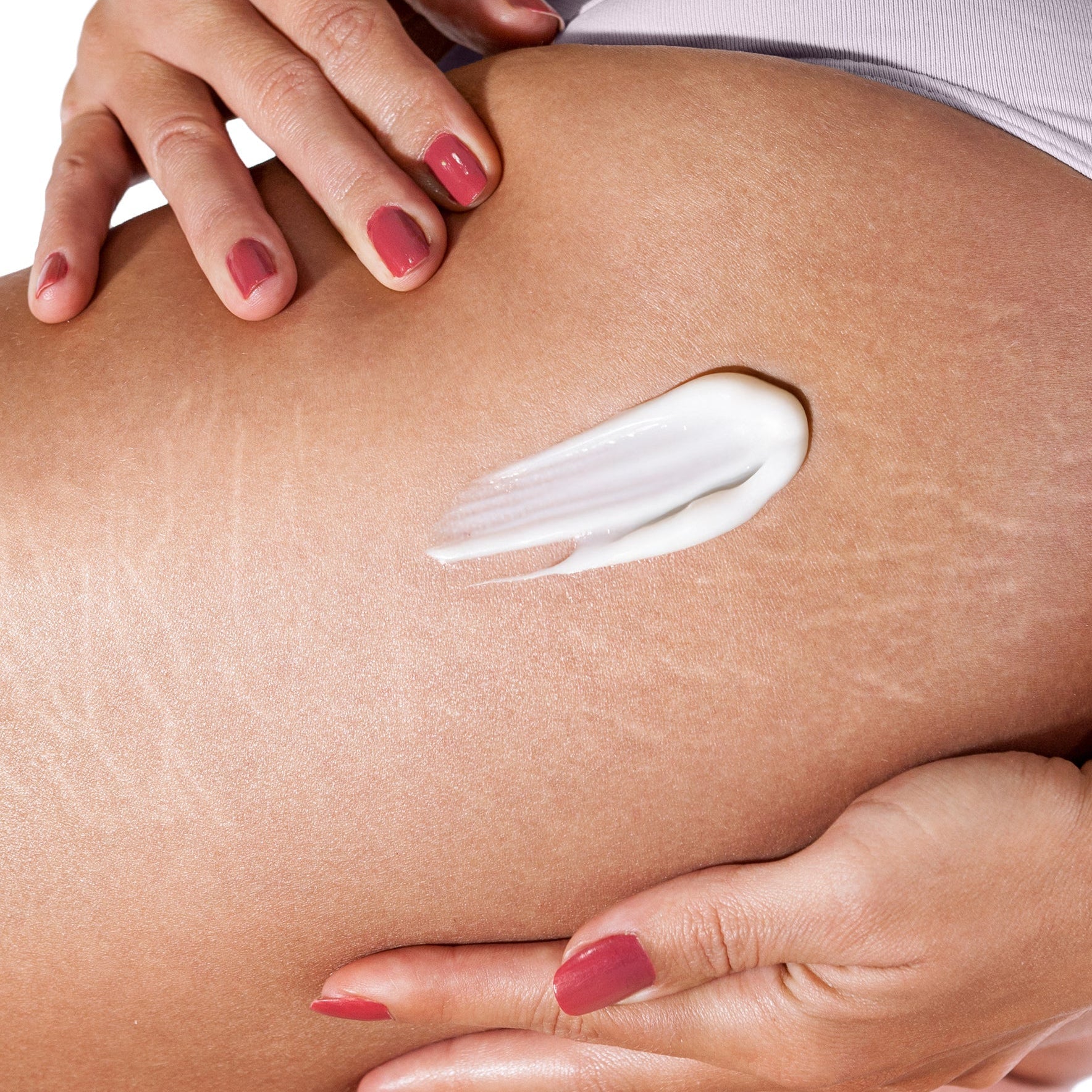 Managing the Appearance of Stretch Marks